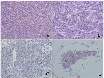 Evolution in endoscopic endonasal approach for the management of hypothalamic–pituitary region metastasis: A single-institution experience